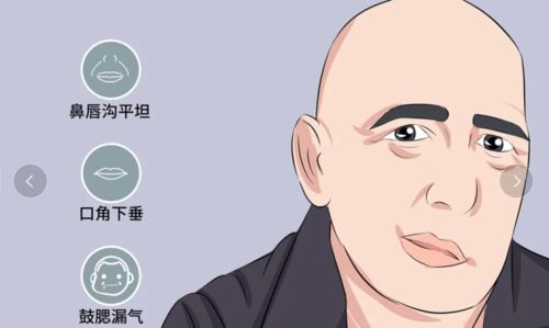 男大夫因贪凉造成面瘫